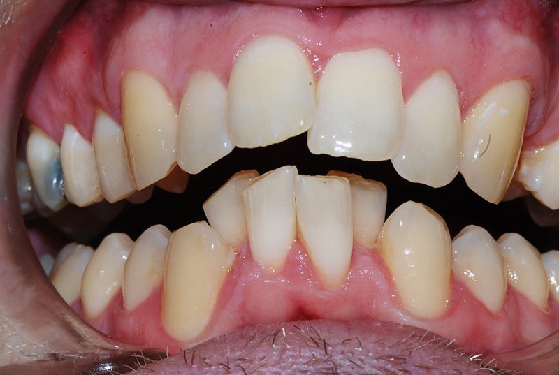 Adult Male Treatment for Crooked Teeth - Billericay Orthodontics